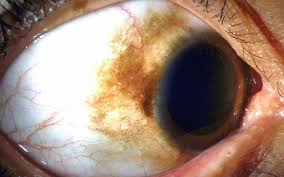 Image result for melanosis sclera