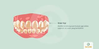 Erosi Gigi Gejala Diagnosis Pengobatan