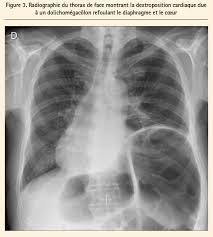 Supprimer le coté gauche ou droit d'un fichier stéréo avec audacity. Dextrocardie Et Pseudodextrocardie Dextroposition Et Dextroversion Que Faut Il Savoir En Pratique Clinique Journal De Cardiologie