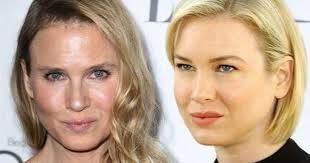 Our surgeon mr miles berry explains the extreme face change of renã©e zellweger. Renee Zellweger S Cosmetic Surgery Confusion