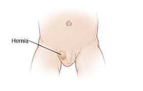 Image result for Inguinal hernia child