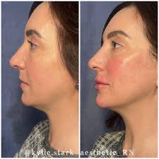 Cheeks and chin for the WIN!! 🤩 💉 ✨ Beautiful, yet natural results for  this sweet patient! With three syringes of Juvaderm Voluma, we achieved  softer undereyes, sharper cheeks bones, and volume