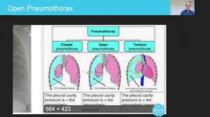 Image result for Open Pneumothorax