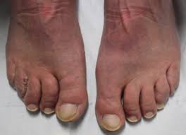 Image result for Yellow nail syndrome feet