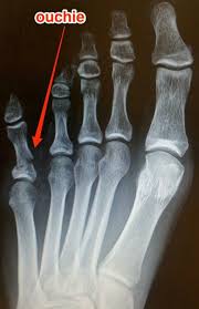 How To Splint Tape And Heal A Broken Pinkie Toe Broken Toe Toes Pinky Toe