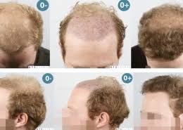 Alexander zink1,2 · katharina kaliebe1,2 · christoph d. Dr Jean Devroye Hts Clinic 3556 Fut Alopecia Diffusa Bellicapelli Forum