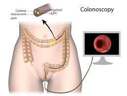 How much does a colonoscopy cost with insurance. Colon Cancer Dallas Colon Screening Colonoscopy Dallas Tx Cost