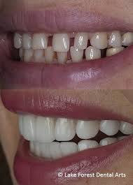They are also stain resistant and maintain a consistent shine for a beautiful smile all day, every day! Spaces Between Teeth Fill Gaps In Your Smile Create Symmetry