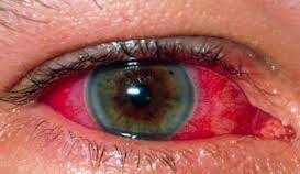 Here are the top 10 causes of red eye, from pink eye to 18 reasons you may have red and bloodshot eyes. Red Eye Outbreak Now Affecting Entire Island Health Officials Say Dominica News Online