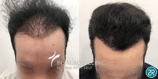 A hurricane and marketing woes couldn't keep these persistent franchisees down. Fotografie Pre E Post Trapianto Di Capelli A Roma Dott Ssa Insalaco