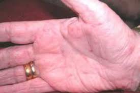 Image result for scabies transmission