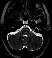 We do the middle ear surgery for otosclerosis but the noise has persisted. Frontiers Perilymphatic Fistula A Review Of Classification Etiology Diagnosis And Treatment Neurology
