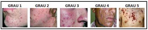Confira lista com os produtos antiacne que ajudam a cuidar da pele. Tratamento Estetico Para Acne Vulgar Pubsaude