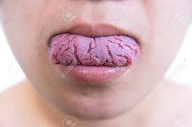 Image result for Fissured tongue