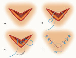 Image result for Corner Stitch