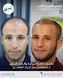 مجمع الحسني الطبي. قسم زراعة الشعر و معالجة تساقط الشعر