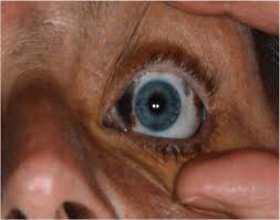 Image result for nevus sclerae
