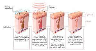 This article will help you understand the treatments and make a choice people looking to permanently remove facial and body hair have a couple of strong and proven options with laser hair removal and intense pulsed light. What Is The Difference Between Ipl Hair Removal And Laser Hair Removal Ebeauty Machine