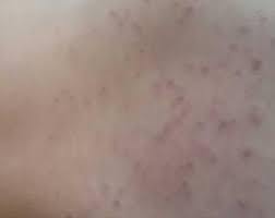 tuy dokucu krem sonrasi sivilce nasil gecer kizlarsoruyor