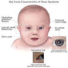 Clinical Pathology Glossary: Down Syndrome