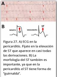 La miocarditis puede afectar al músculo y al sistema eléctrico del corazón, reduciendo la capacidad cardiaca de bombear y de producir ritmos cardiacos anormales o rápidos, es decir, arritmias. Como Es El Ecg En Las Pericarditis Patrones Ecg En Patologia Cardiaca Steemit