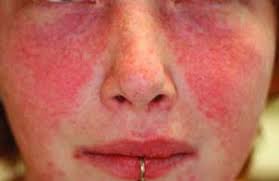 Connective Tissue Disease And Vasculitis Related Dermatoses Plastic Surgery Key