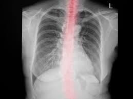 Home remedies for chest congestion. Home Remedies For Chest Congestion How To Get Rid Of Mucus With Ginger Honey And Other Natural Products Health Tips And News