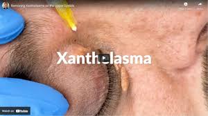 Image result for xanthelasma of eyelid
