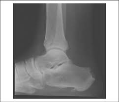 Haglund's deformity is where bone grows on the heel bone (calcaneus). Lateral View Of An Ankle Radiograph Showing A Pronounced Haglund Download Scientific Diagram