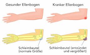 Für die bewegung des armes kommt dem ellenbogen eine bedeutende rolle zu und er wird daher auch im alltag stark beansprucht. Schmerzen Im Ellenbogen Ursachen Einfache Losung Liebscher Bracht
