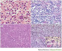 Post Transplant Lymphoproliferative Disorders Nature Reviews Disease Primers