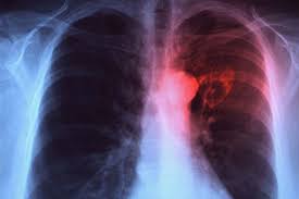 Pin On Health Shoulder Chest Back Injury