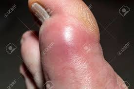 Check spelling or type a new query. The Inflammation And Discoloration Of The Big Toe Due To Gout Stock Photo Picture And Royalty Free Image Image 151668059