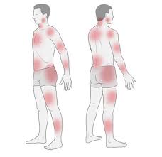 Fibromyalgia Informedhealth Org