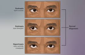 Image result for Strabismus