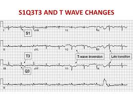 L ecg può risultare normale dal 10 al 25% dei pazienti con embolia polmonare (3,4), ma più diagnostic value of the electrocardiogram in suspected pulmonary embolism. What Is S1q3t3