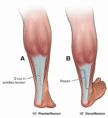 Many also do not suffer from prolonged health problems. Achilles Tendon Lengthening Musculoskeletal Key