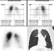Image result for Ventilation Perfusion Scan