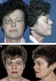 Avoiding Surgery For Thyroid Eye Disease Eye