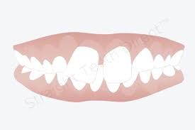 Do you want to become a better version of yourself? Teeth Gaps Can They Be Closed Without The Use Of Braces
