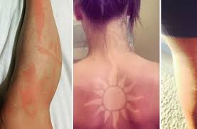 Furthermore, her hair color is dark brown and eye color is green. Sunburn Tattoo Challenge Brandgefahrlicher Trend Auf Instagram Panorama Stuttgarter Zeitung