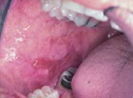 Usually symptoms do not occur until later stages, but some of the earliest stages are blood found in urine, persistent generally speaking one will spot signs of skin cancer in its very early stages if that person is regularly checking their bodies thoroughly and knows. Oral Cancer Images The Oral Cancer Foundation