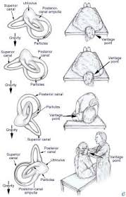 Image result for Vertigo Management