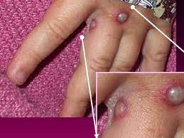It is closely related to smallpox but is not nearly as deadly as smallpox was. Tm Gpvbfagqrrm