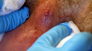 Whether the pocket of pus is called a boil or a. Huge Abscess Staph Infection Popped In Armpit Huge Plug Removed Best Abscess Drainage Ever Video Dailymotion
