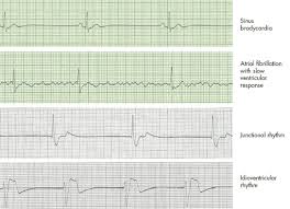 A review of the literature. A Tale Of Two Pulseless Electrical Activity Cardiac Arrest Rhythms Consultant360