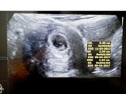 What To Expect At Your Six Week Ultrasound Appointment
