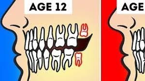 There are three main reasons why wisdom teeth may be lacking inside the mouth: Do You Really Need To Get Your Wisdom Teeth Pulled Youtube