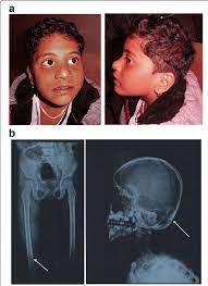 Rhinoplasty + epicanthal folds q&a. A Clinical Picture Of The Proband Showing Features Of Microcephaly Download Scientific Diagram