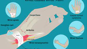 A strained wrist cannot actually occur; Wrist Pain Causes Treatment And When To See A Doctor
